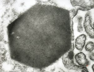 F,1y. | Charcot-Leyden crystal - histiocytosis X